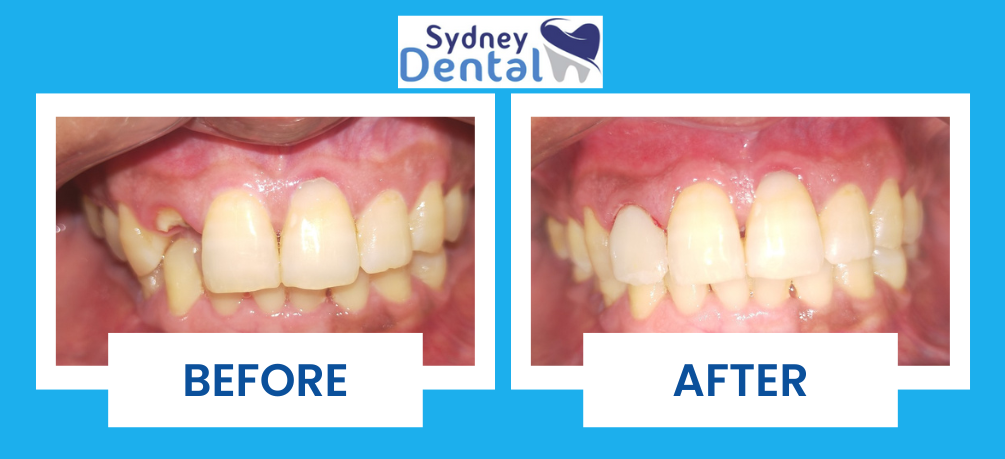 Broken Tooth Treatment with Fiber Post & Composite Restoration in ...